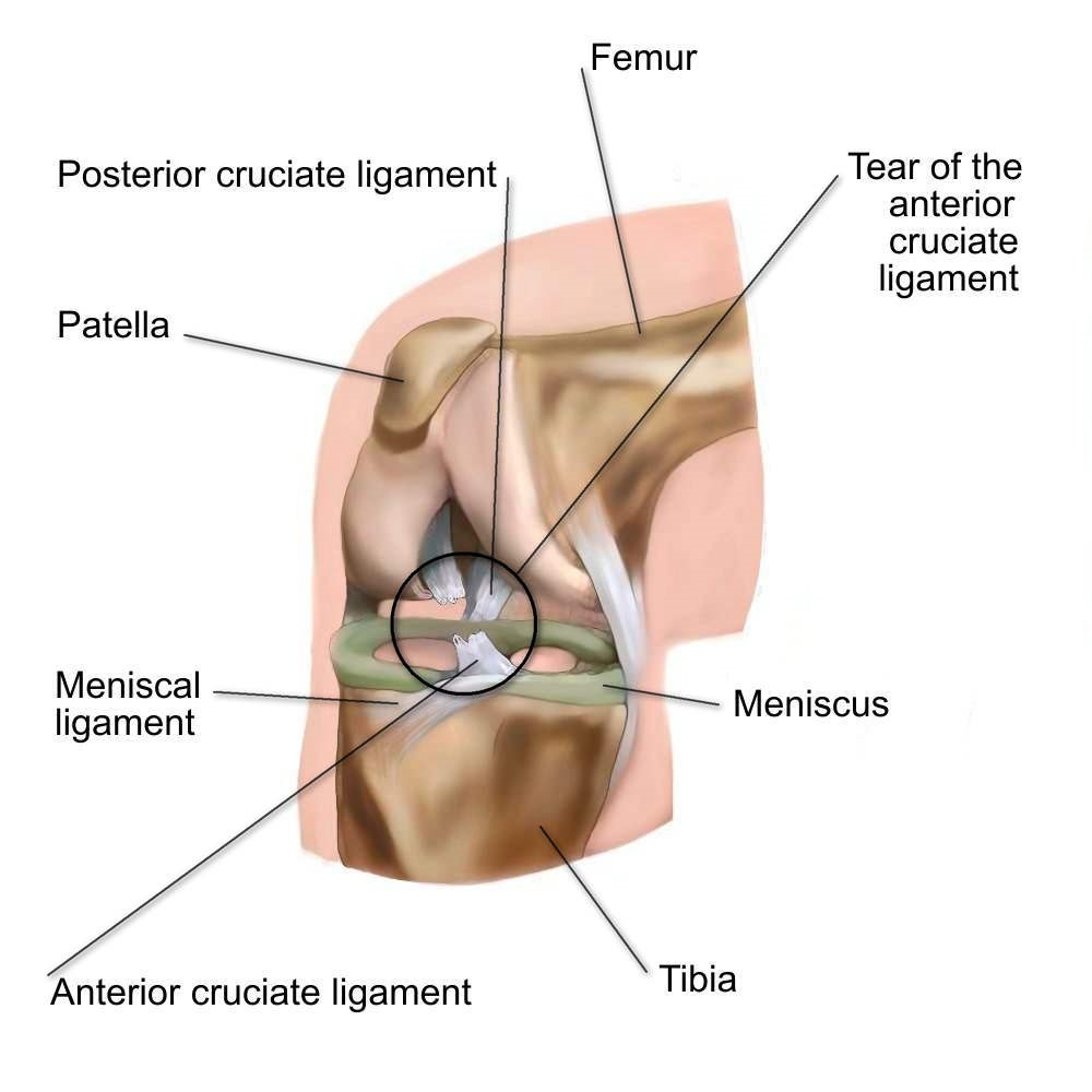 ACL Tears - Physio Direct NZ