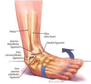 Ankle Sprains - Physio Direct NZ