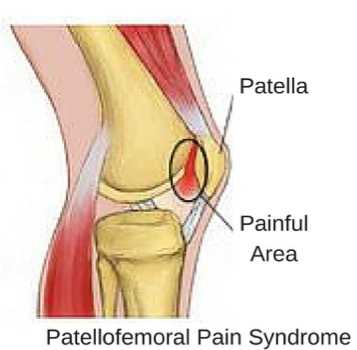 Runner’s Knee (Patellofemoral Pain Syndrome) - Physio Direct NZ