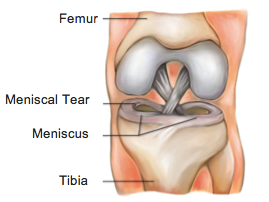 Meniscal Tears - Physio Direct NZ
