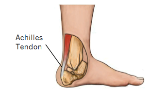 Achilles Tendon Tears - Physio Direct NZ