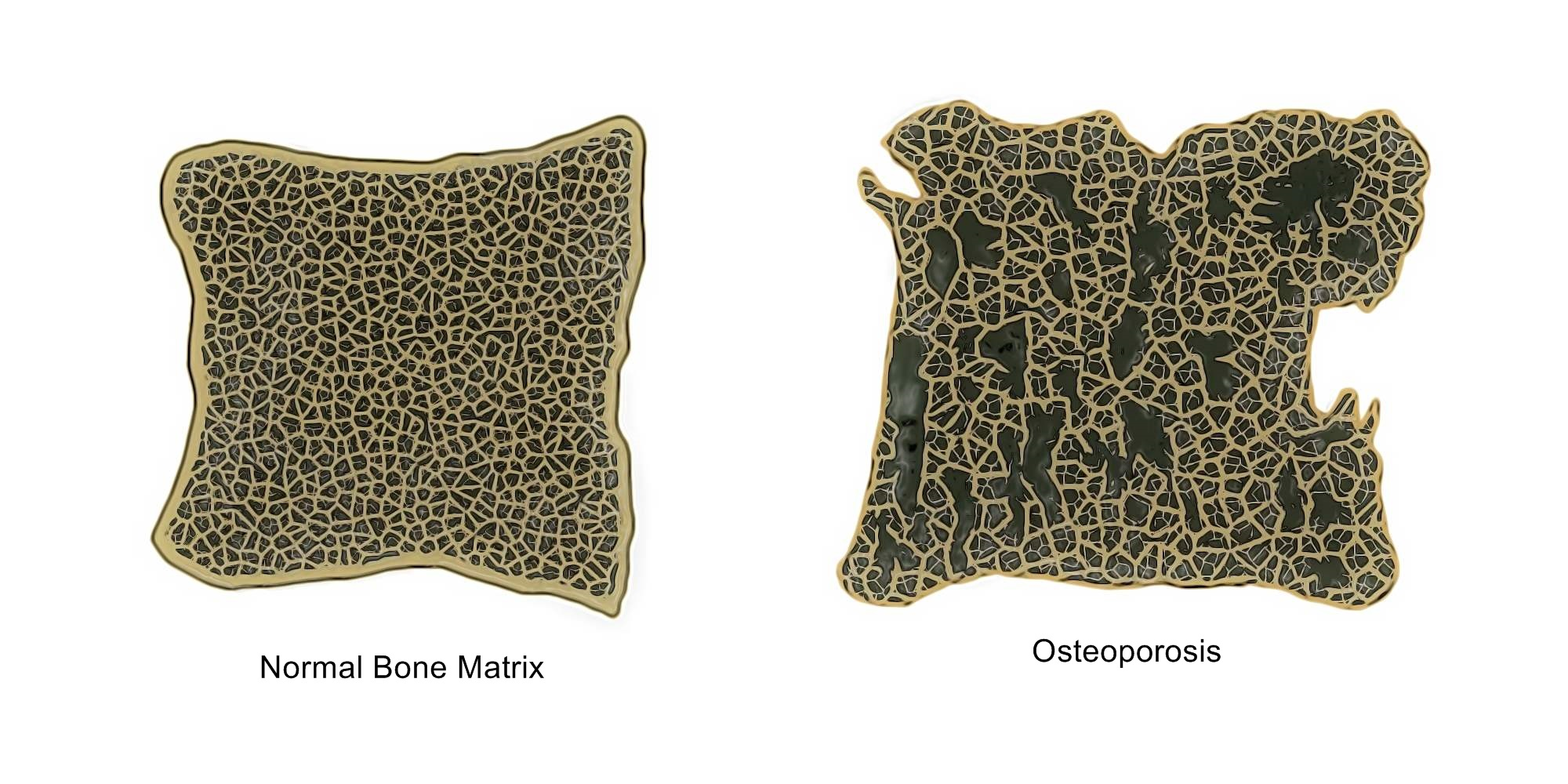 Facts About Osteoporosis - Physio Direct NZ