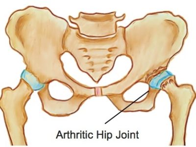 Osteoarthritis of the Hip - Physio Direct NZ