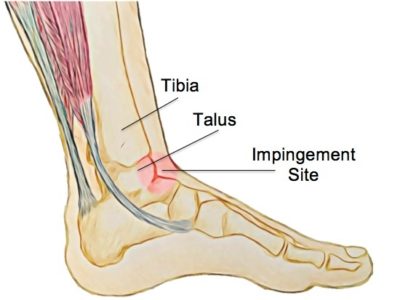 Anterior Ankle Impingement - Physio Direct NZ