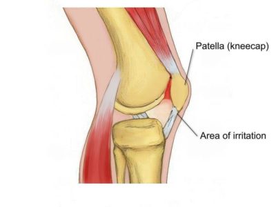 Runner’s Knee                       (PFJ Syndrome) - Physio Direct NZ