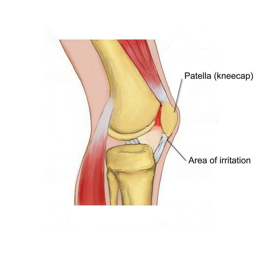 Runner’s Knee                       (PFJ Syndrome) - Physio Direct NZ