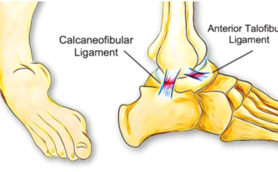 Can Poor Balance Lead To Ankle Sprains? - Physio Direct NZ