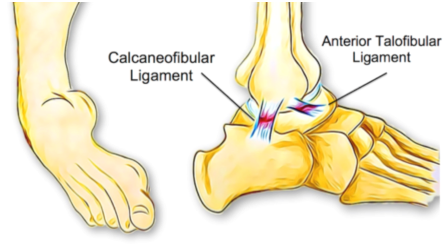 Can Poor Balance Lead To Ankle Sprains? - Physio Direct NZ