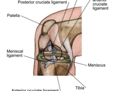ACL Tears - Physio Direct NZ