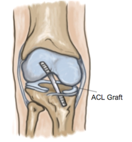 Focus on ACL Reconstructions - Physio Direct NZ