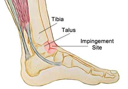 Anterior Ankle Impingement - Physio Direct NZ
