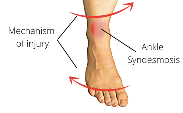 Focus On High Ankle Sprains - Physio Direct NZ