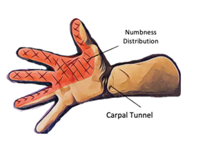 Focus on Carpal Tunnel Syndrome - Physio Direct NZ