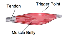 Muscular Trigger Points - Physio Direct NZ