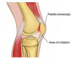 Patellofemoral Pain Syndrome - Physio Direct NZ